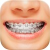 Braces