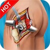 Hip Surgery